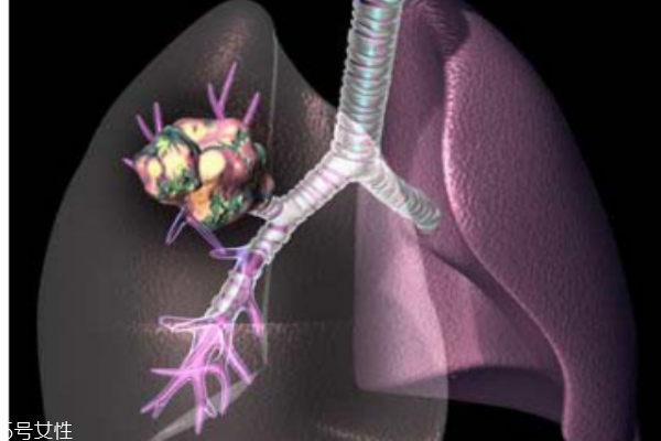 揪出早期肺癌 低剂量电脑断层检查